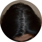 women hair transplant