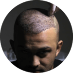 hair transplant