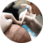 hair transplant