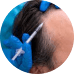 hair transplant
