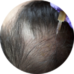 Hair transplant
