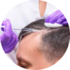 hair transplant