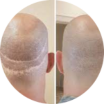scar transplant