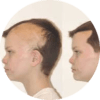 hair transplant