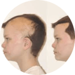 hair transplant