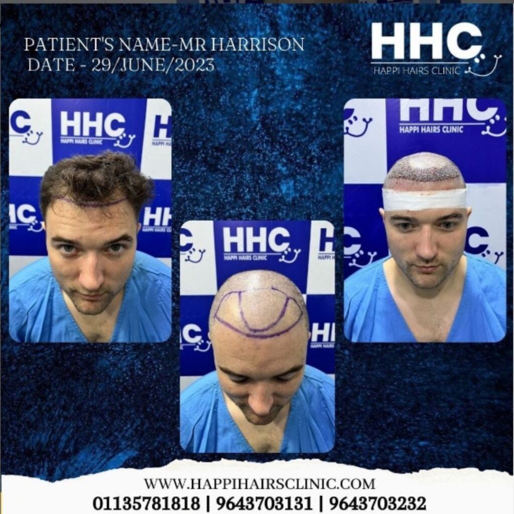 happi hairc clinic clinet before after of hair transplant image-3