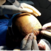 Hair transplant