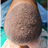 Hair transplant