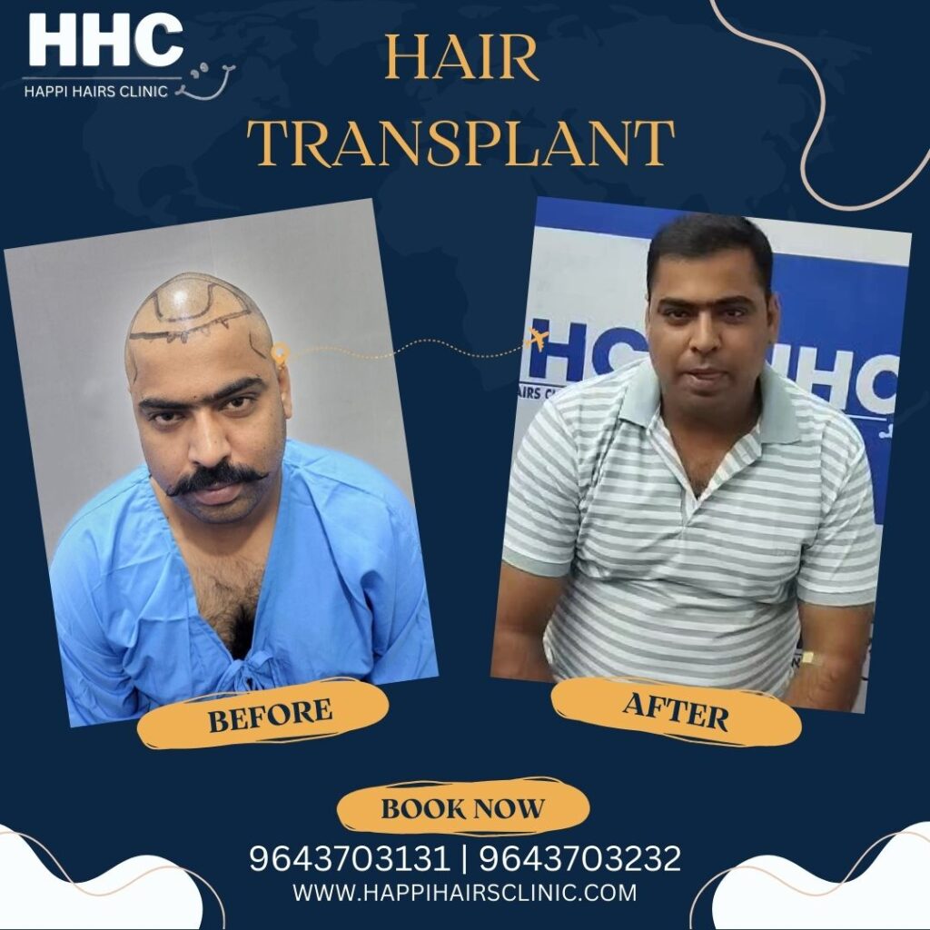 Hair transplant