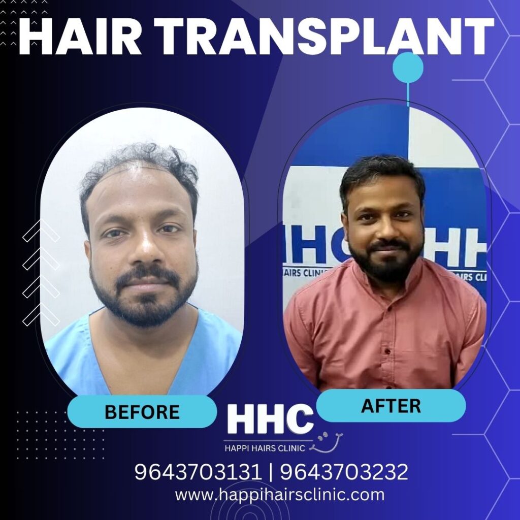 hair transplant
