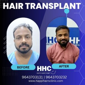 hair transplant