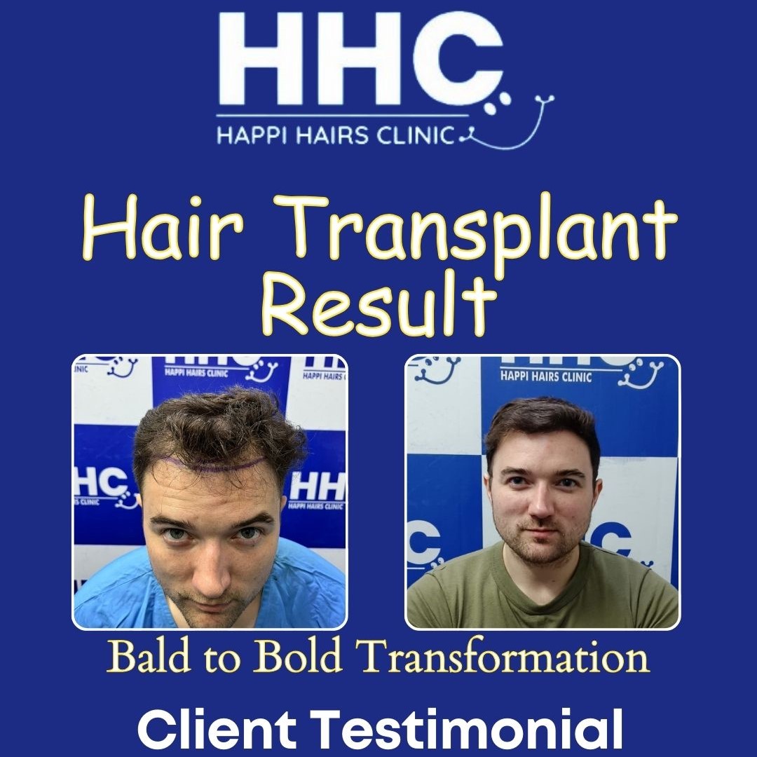 Contact the Premier Hair Transplant Clinic in Delhi