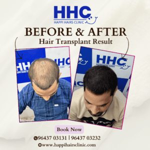 Hair Transplant Before and After