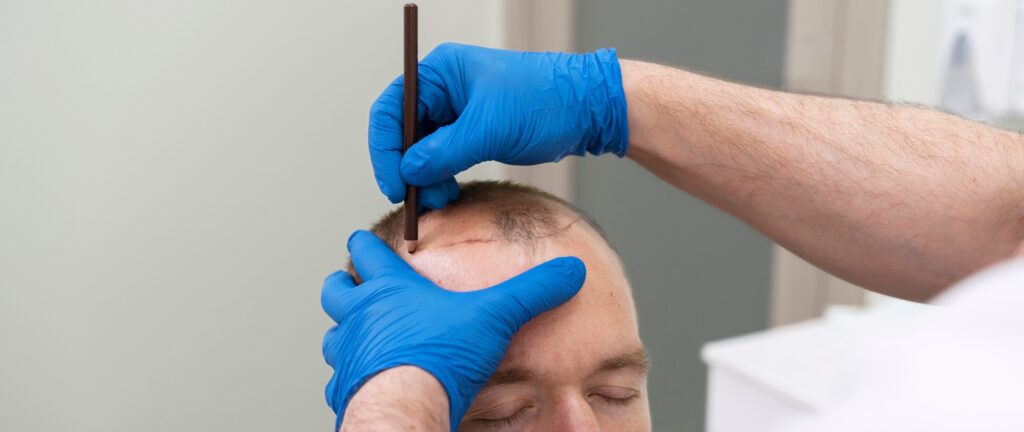 Best Hair Transplant Clinic in India