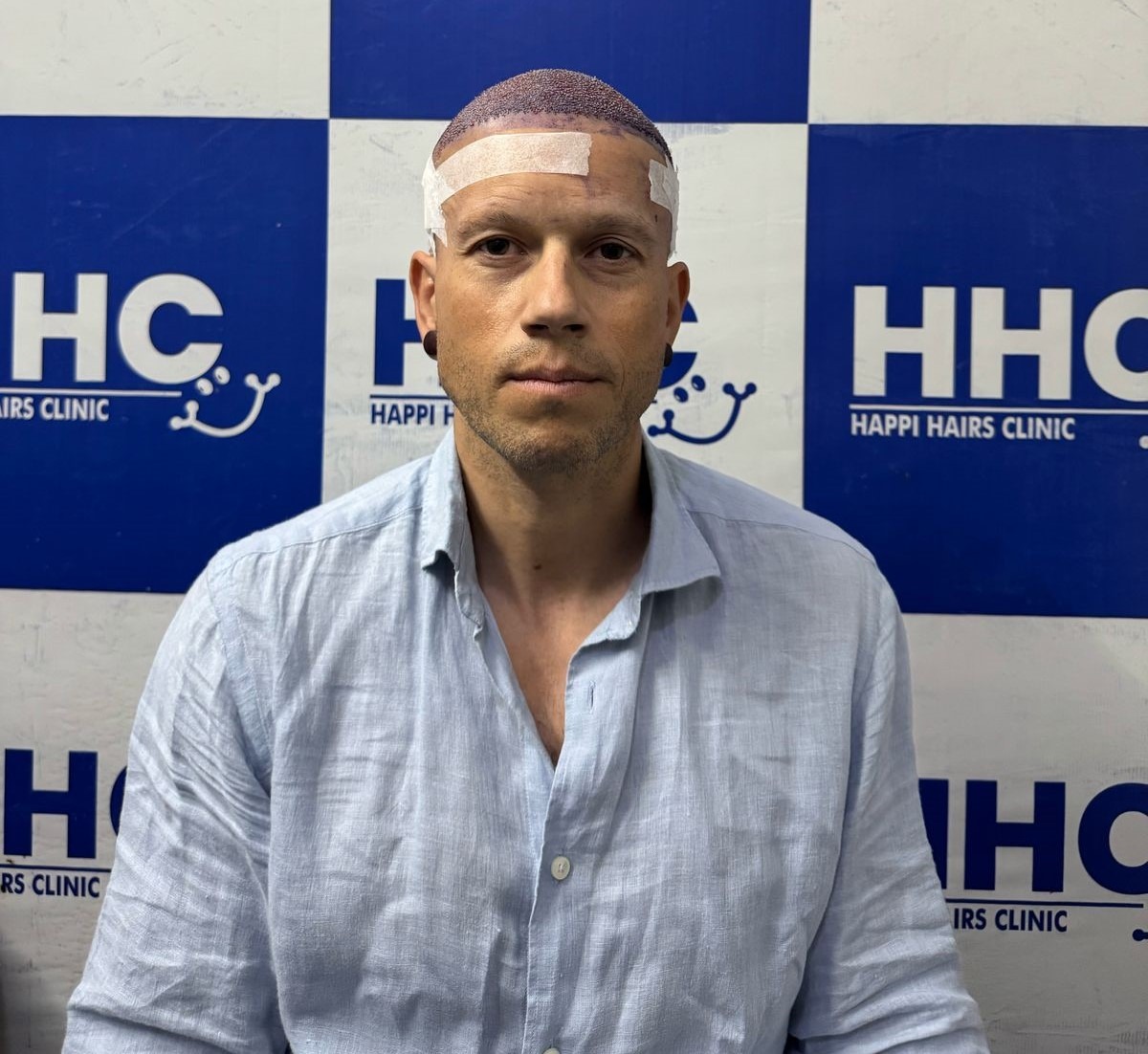 hair transplant